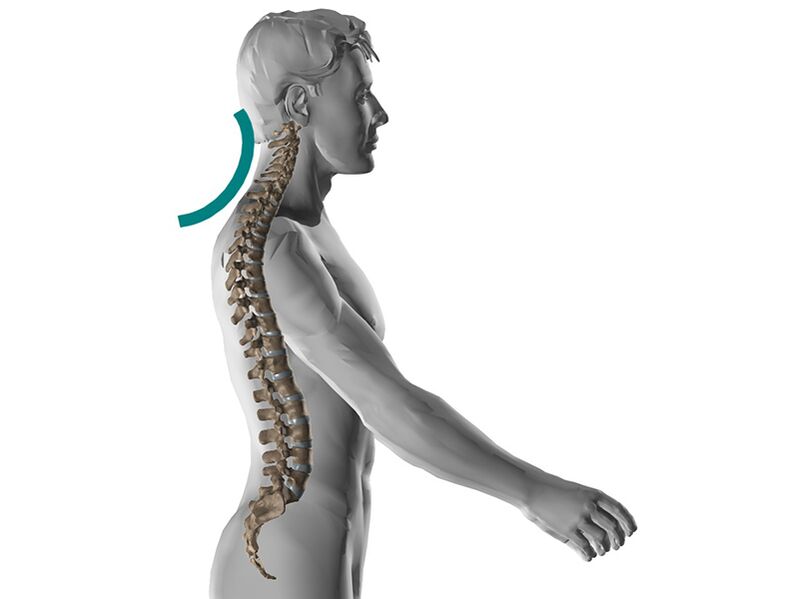 Cervicale osteochondrose van de wervelkolom, die veel onaangename symptomen veroorzaakt