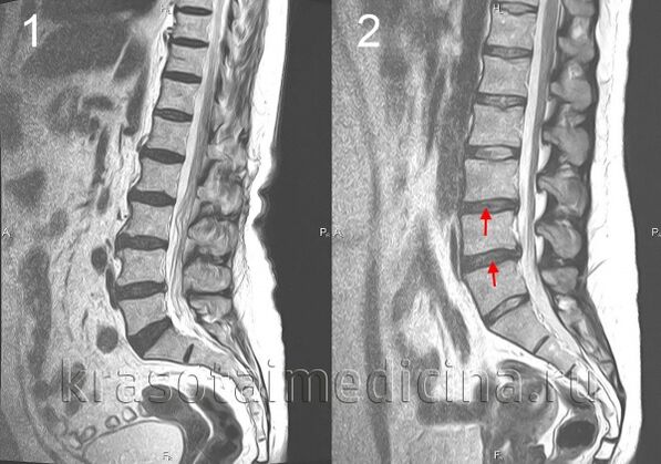 spinale osteochondrose